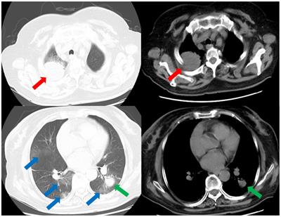 Multiple pulmonary cavities in an immunocompetent patient: a case report and literature review